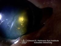 Polychromatic Cataract